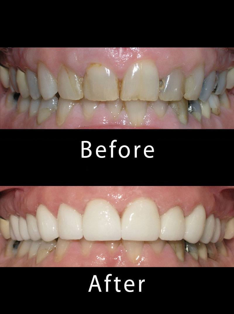 Teeth Whitening Before After Image