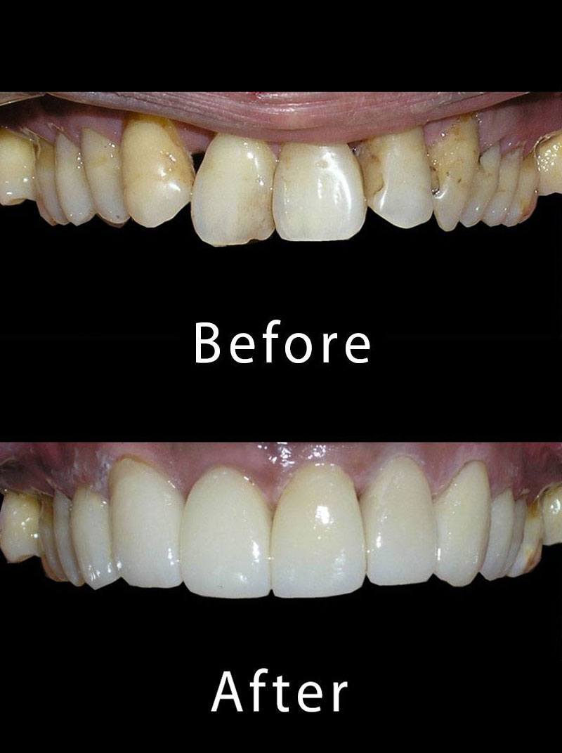 Teeth Cleaning Before After Image