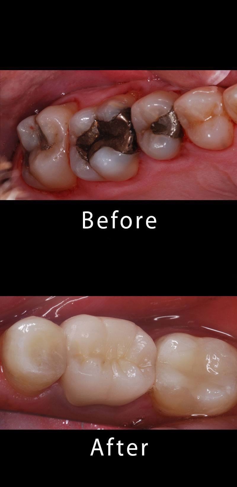 Composite Filling Before After Image