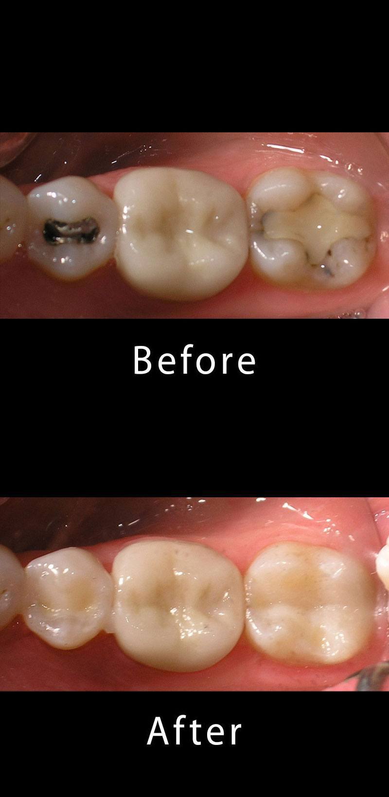 Composite Filling Before After Image