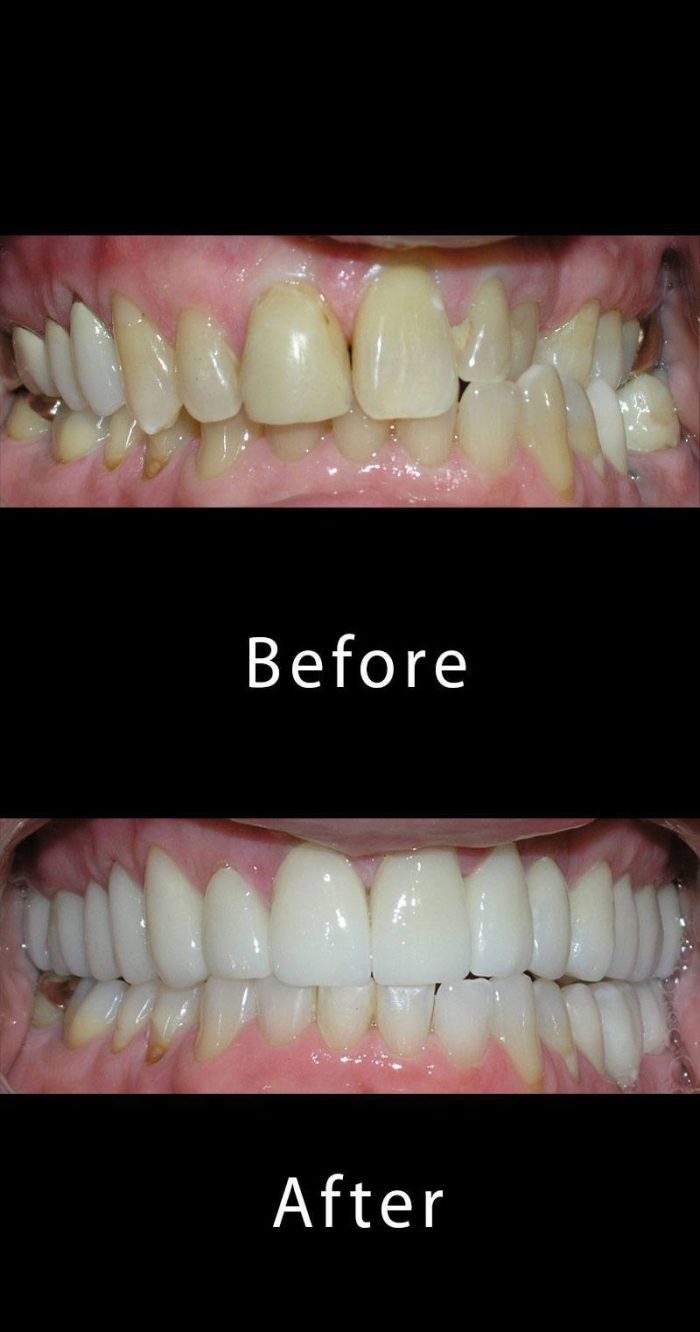Before and After Dental Gallery Advanced Dental Arts