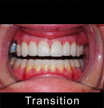 Dental Implants Before After Image