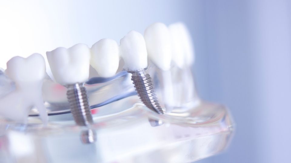 What Materials Are Dental Implants Made From?